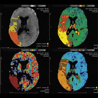 Программное обеспечение для службы экстренной помощи SPHERE 3.0 Stroke CT MR