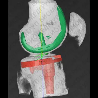 Медицинское программное обеспечение mediCAD 3D Knee