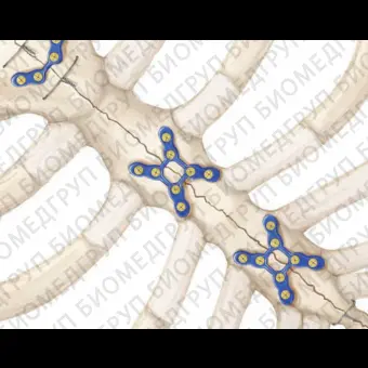 Компрессионная костная пластина торакс SternaLock