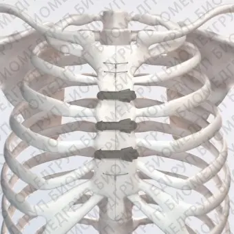 Ортопедическая проволока для закрытия груди STERN FIX