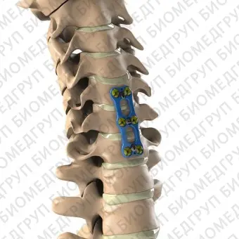 Шейная костная пластина для артродеза  Aditus T6Al4V ELI